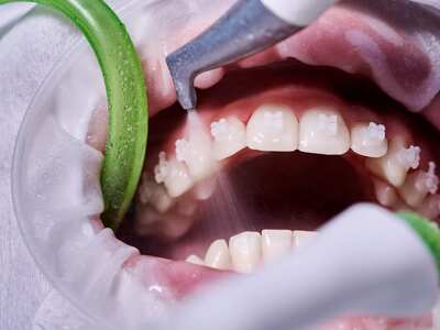 Чистка зубов с брекетами у стоматолога