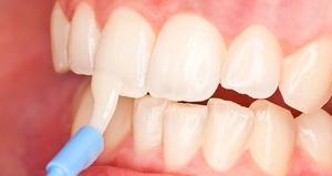 Фторирование молочных зубов с чисткой (1 зуб)