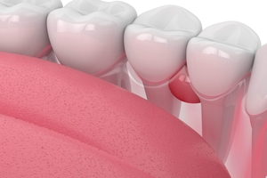 Киста зуба лечение без операции
